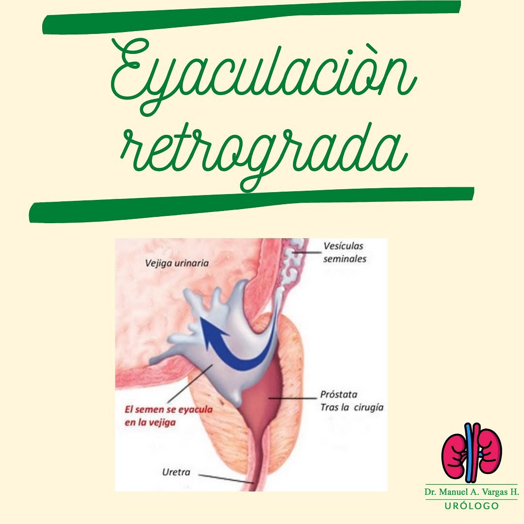 eyaculacion retrogada