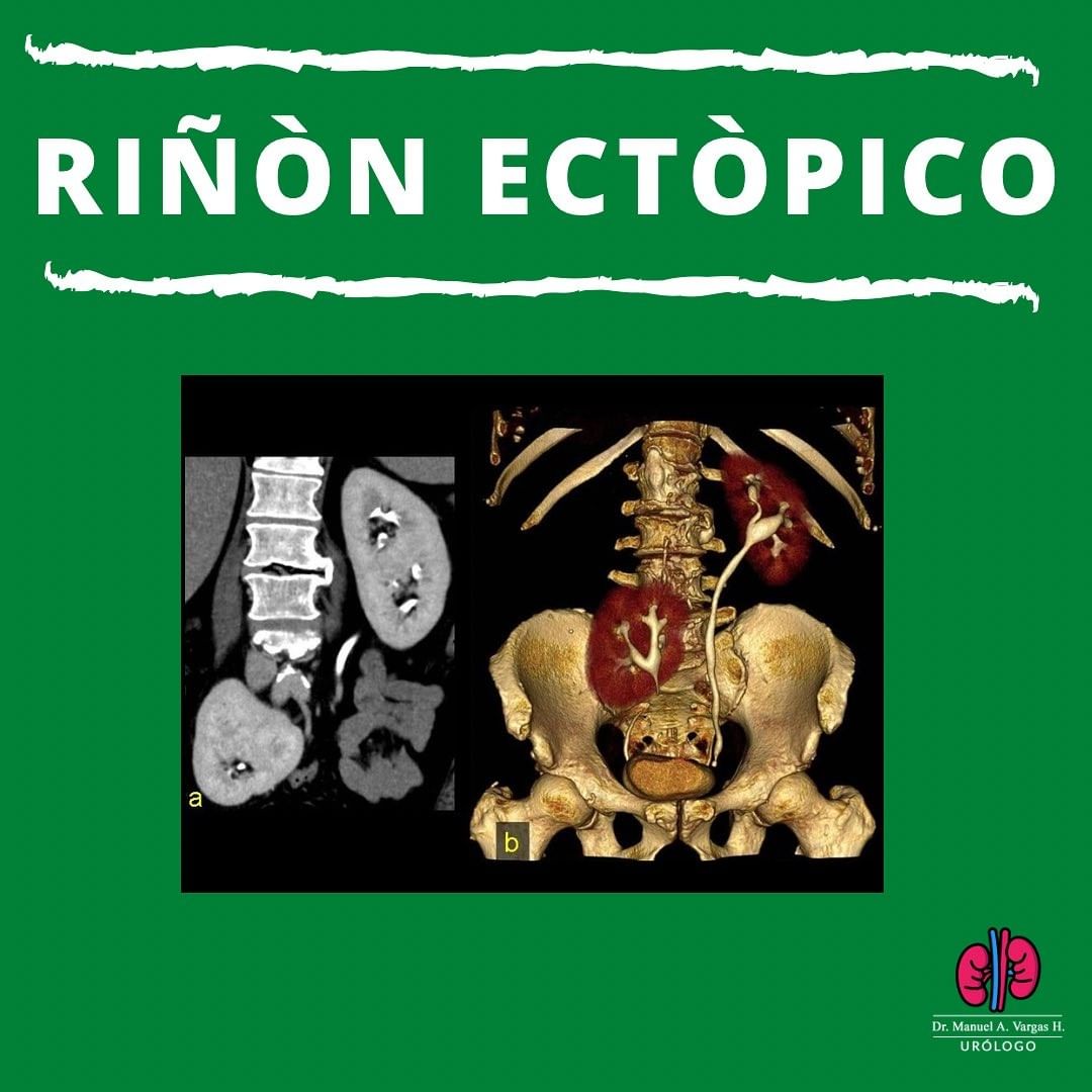 riñon ectopico